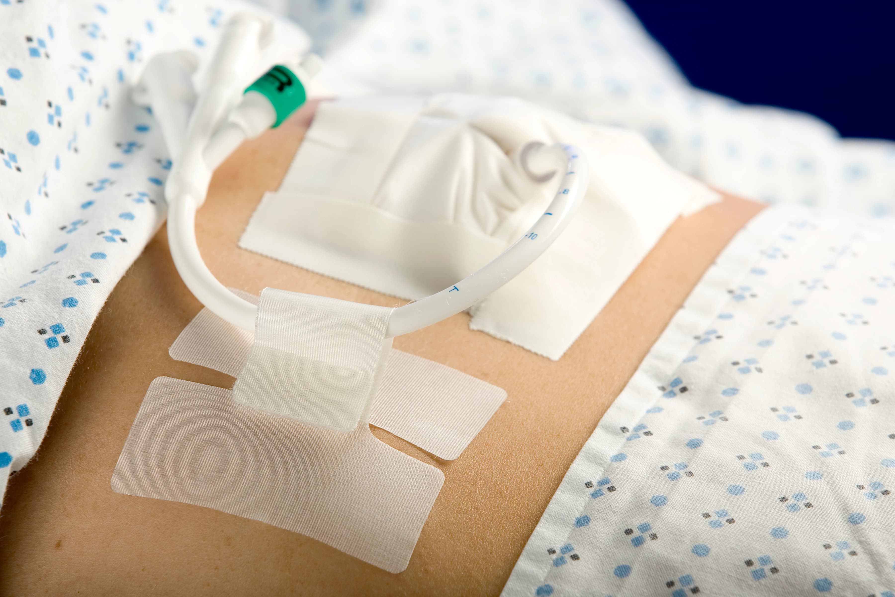 Cath-Secure Foley Catheter Securement Device, Multi-Purpose, 2.5" Long Tab, 3" x 1.75" Base, 50/Bx, MCJ-5445-2 thumbnail 2