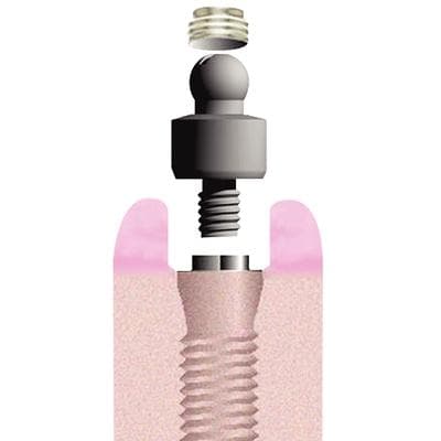 Flexi-Overdenture EZ-Change Keeper & Cap Inserts Intro Kit, Contains 2 Keepers, 2 Cap Inserts, 2 Rubber Bands, 1 EZ-Change Wrench thumbnail 7