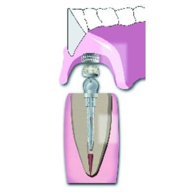 Flexi-Overdenture Attachment Caps, Nylon Female Caps with Rubber Bands, Fits All Sizes, 6/Pkg, 290-01 thumbnail 7