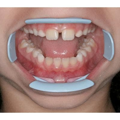 ComfortView Lip & Cheek Retractor, Universal, White, 2/Box, 9061381 thumbnail 17