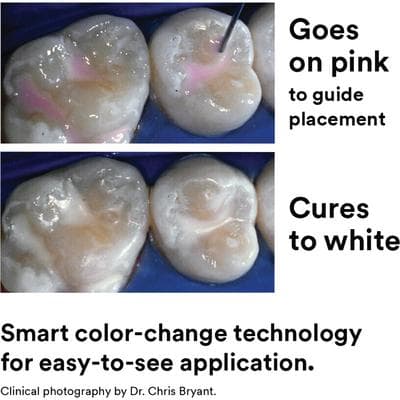3M Clinpro Sealant Refill Syringe, 1.2 ml, Light-Cure Fluoride-Releasing Pit & Fissure Sealant, Pink to White Color-Change, with 10 Dispensing Tips, 12627 thumbnail 14