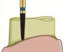 Alpen Multi-Use Multilayer Diamond FG #878.010 Beveled Cylinder, Coarse Grit, 5/Pkg thumbnail 3