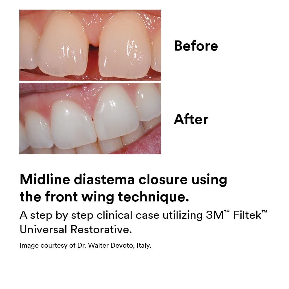 3M Filtek Universal Restorative Capsules, Shade B2, 0.2 g, 20/Pk, 6550B2 thumbnail 7