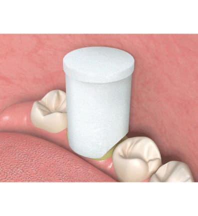 Premier Traxodent Retraction Caps, Size #3 Medium, Anatomic Formed Cotton, 120/Pk, 9048253 thumbnail 7