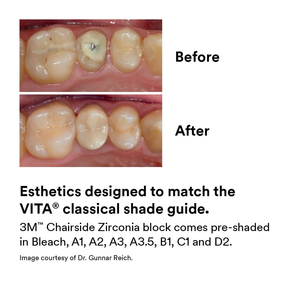 3M (Solventum) Chairside Zirconia Bridge Block for CEREC, 39 mm, Shade BL (Bleach), Refill, 3/Pk thumbnail 6