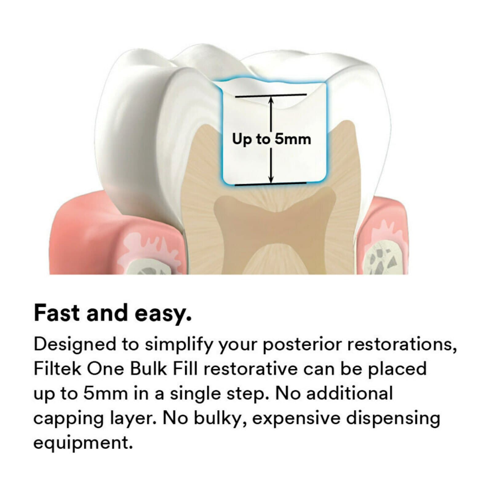 3M Filtek One Bulk Fill Restorative, A1, 4g Syringe Refill, 4866A1 thumbnail 10