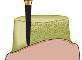 Alpen® Multi Use Diamond Bur, FG, Super Coarse, Black, Curettage/Pointed Taper Cone, #878K, 2.3 mm Diameter, 8.0 mm Length, 5/Pkg