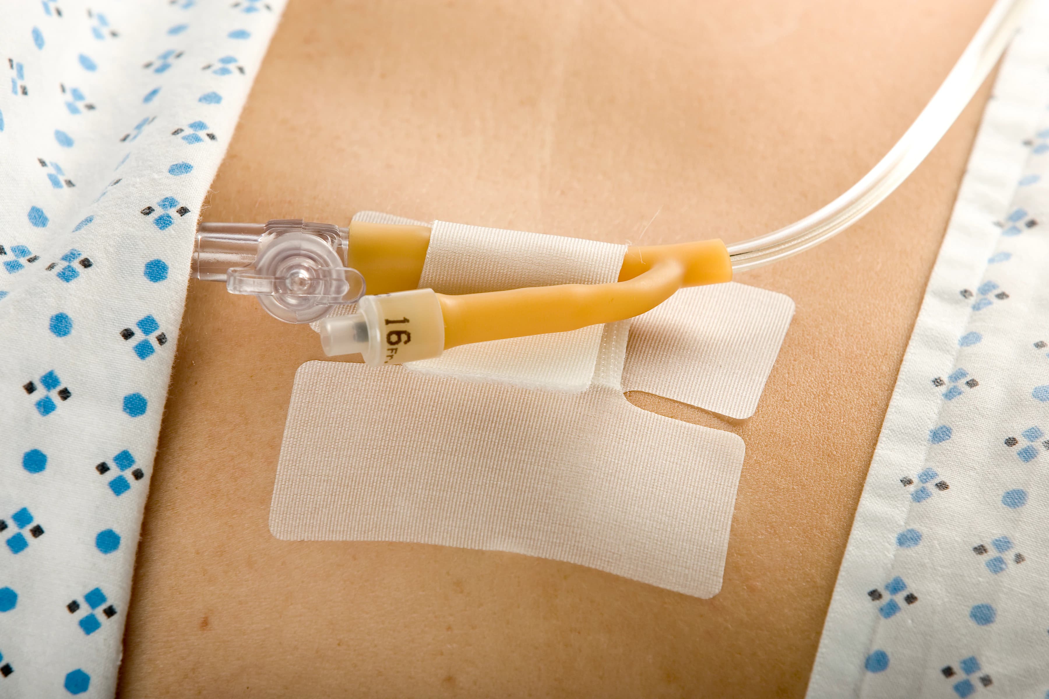 Cath-Secure Foley Catheter Securement Device, Multi-Purpose, 2.5" Long Tab, 3" x 1.75" Base, 50/Bx, MCJ-5445-2 - Securement Device Foley Multi-Purpose 2.5'' Long Tab. 3'' x 1.75'' Base 50Bx - Image 1